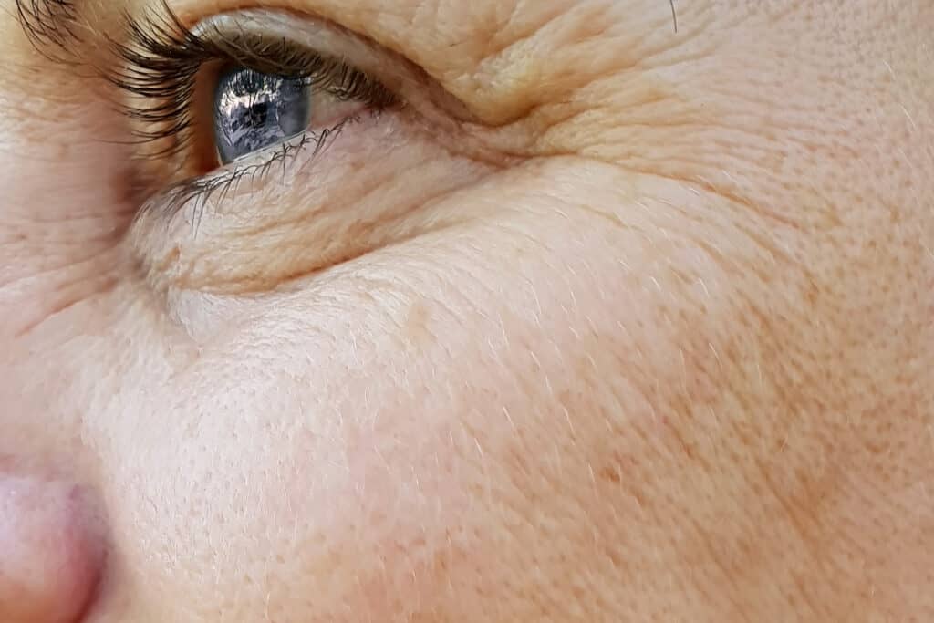 Fine lines and wrinkels reduction Quincy Milton Boston MA