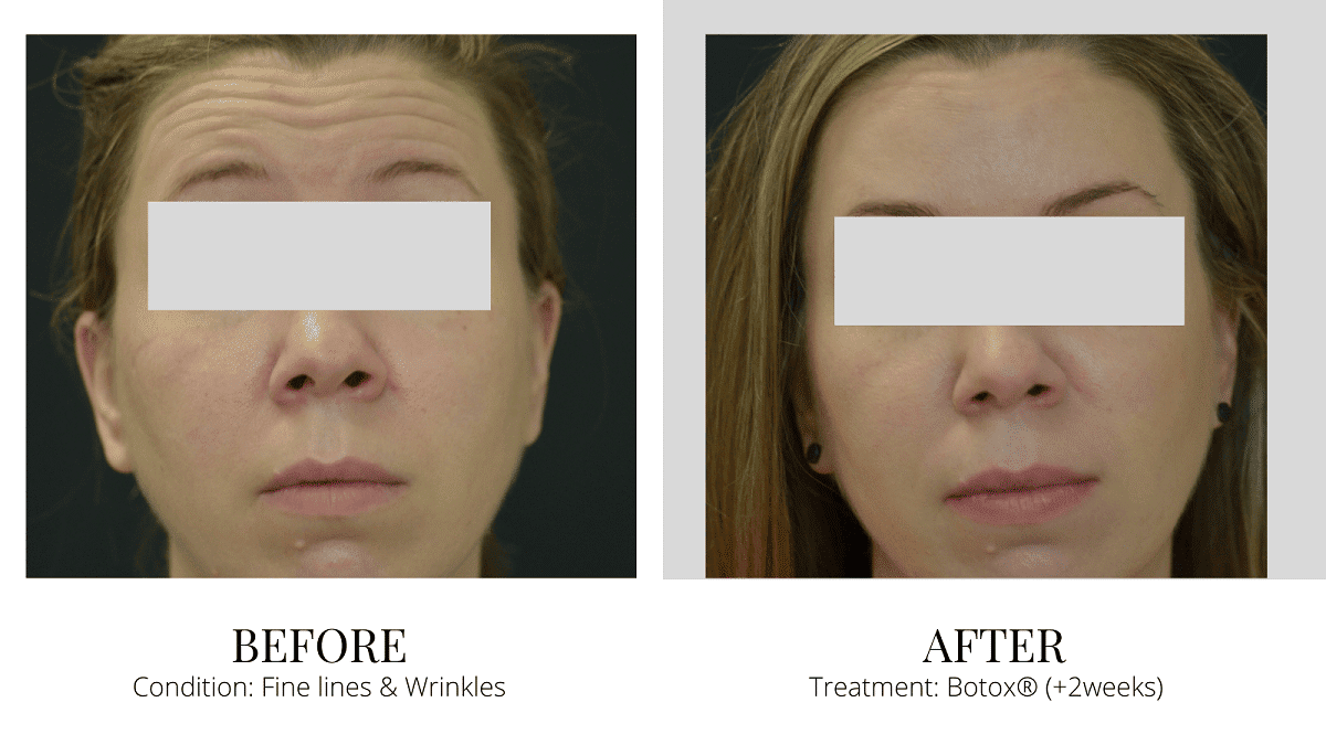 Botox & Dysport before and after Marina Bay Quincy MA
