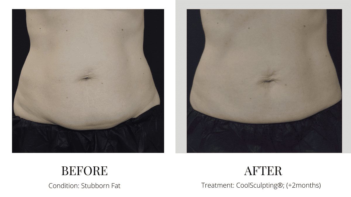 CoolSculpting belly fat removal before and after