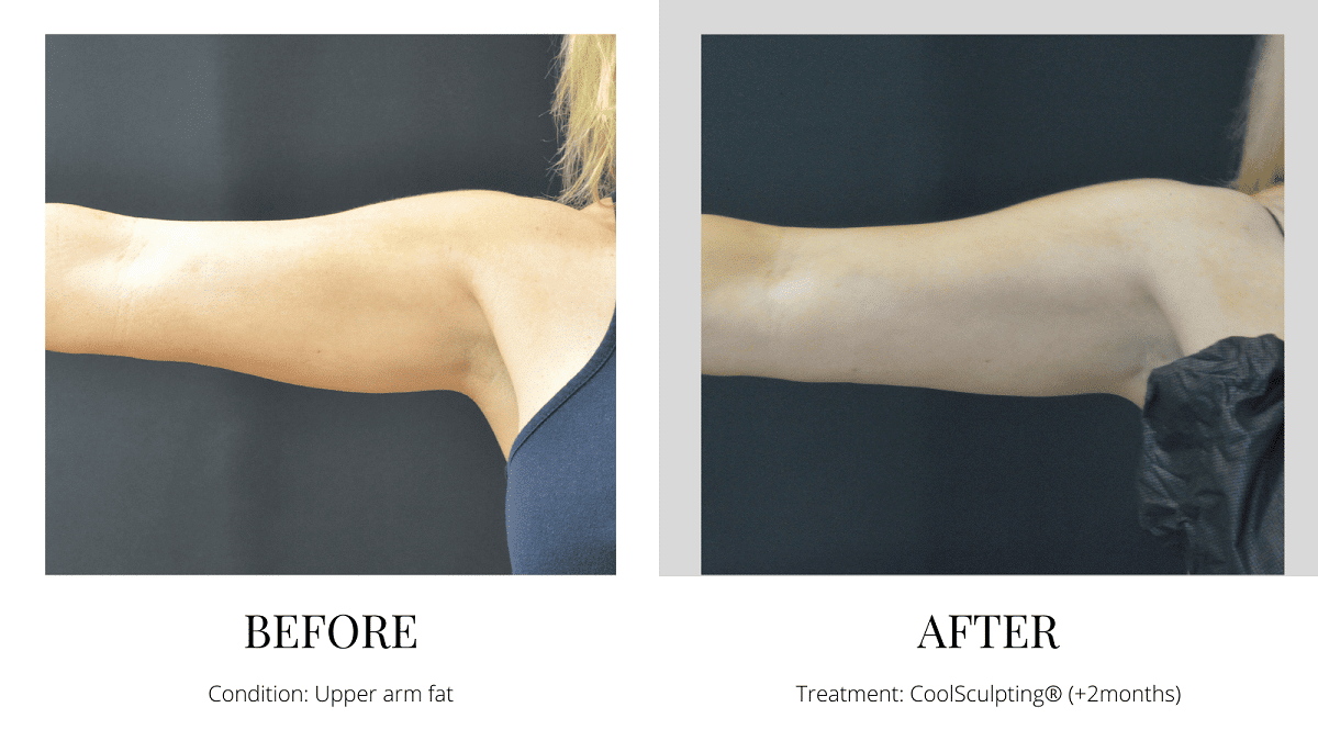 CoolSculpting under arm before and after