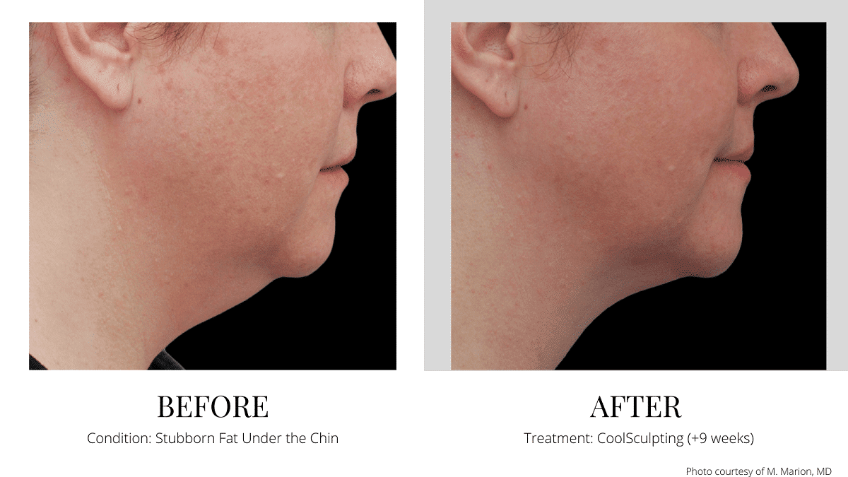 CoolSculpting under chin before and after