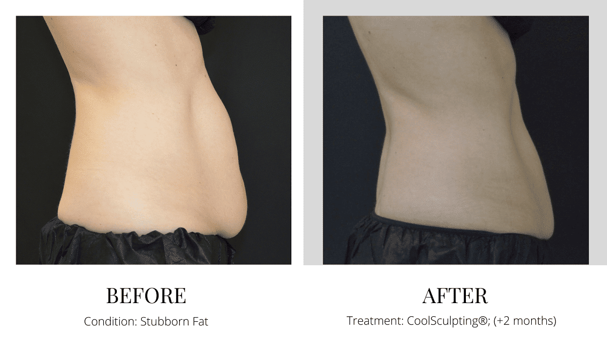 CoolSculpting Abdomen before and after