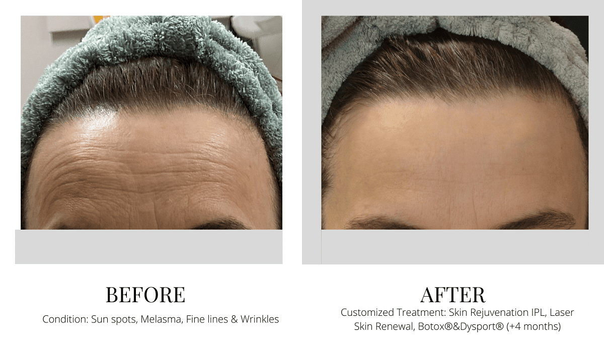 Skin Revitalization treatment Before and After Quincy MA