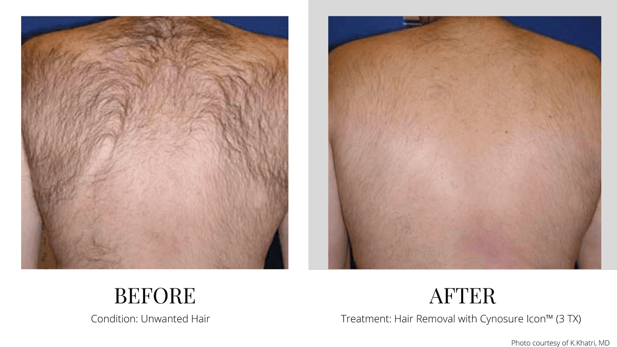 Hair Removal back Quincy Milton Boston MA