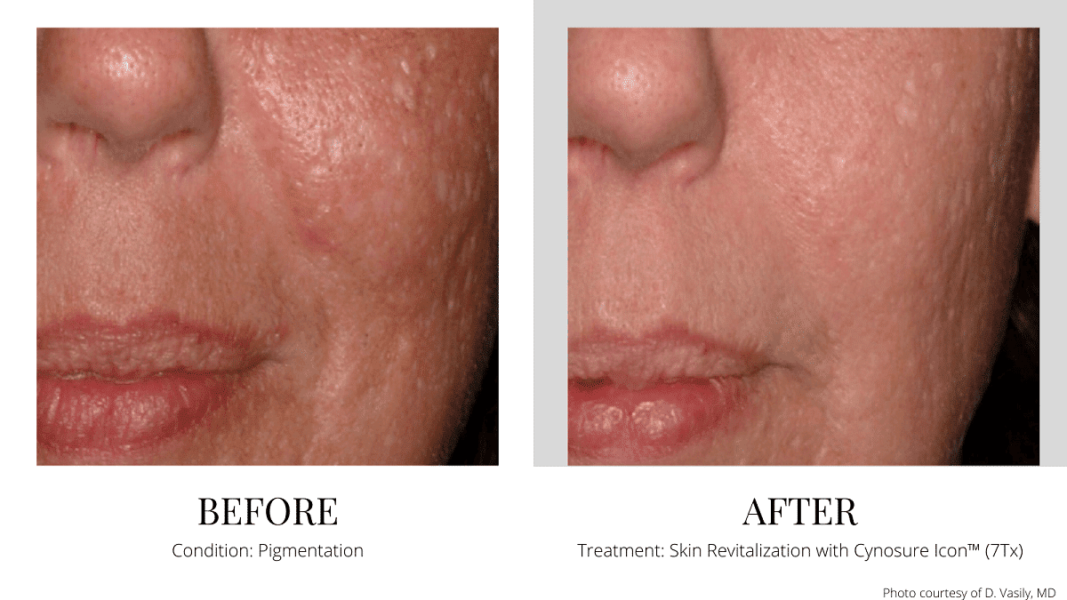 Laser Scar Removal Acne Quincy Milton Boston MA