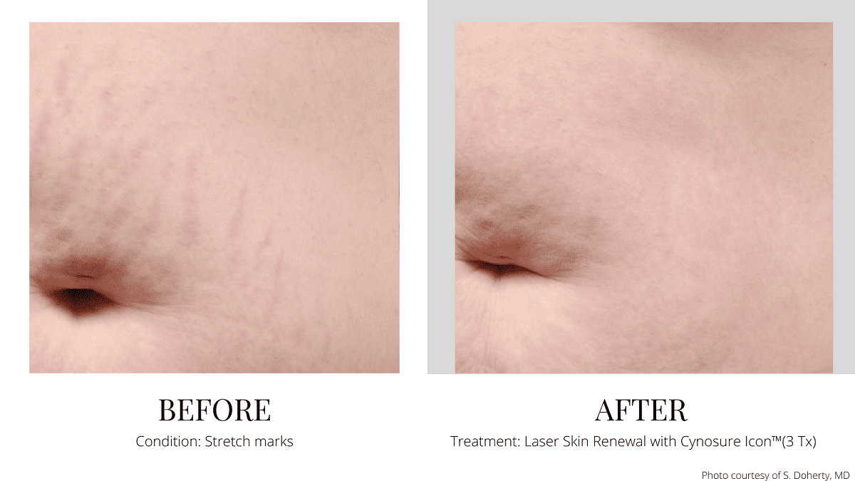 Laser Stretch Mark Removal Before and After Marina Bay Quincy MA