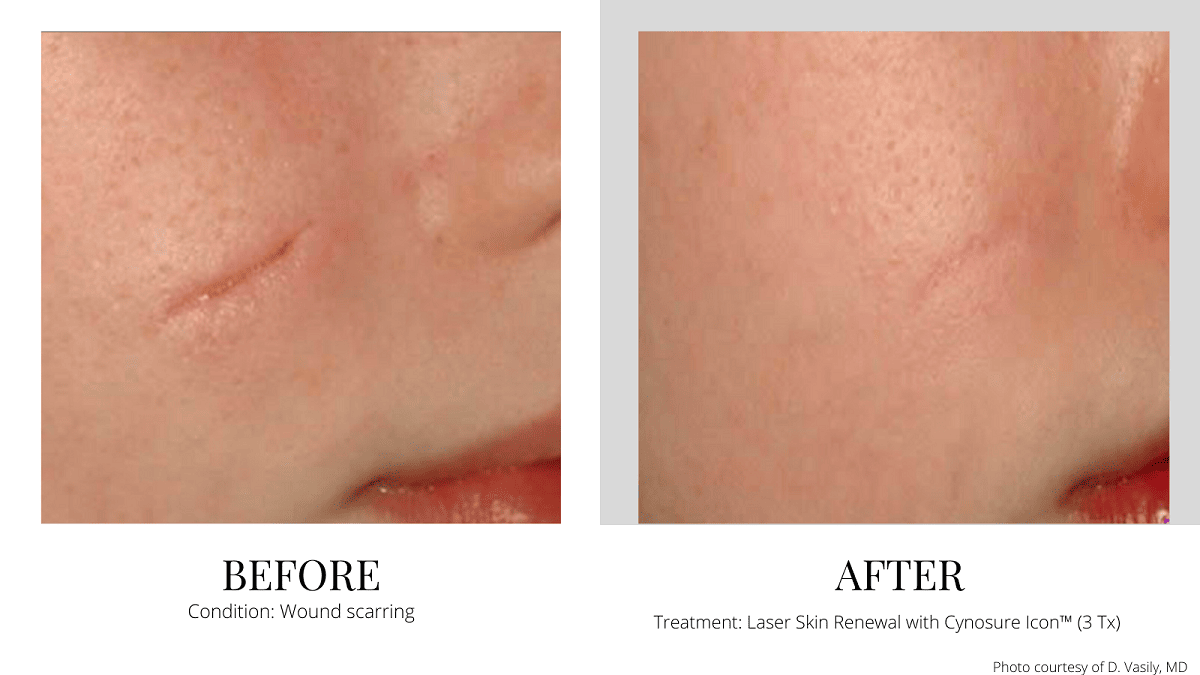 Laser scar removal wound Quincy Milton Boston MA