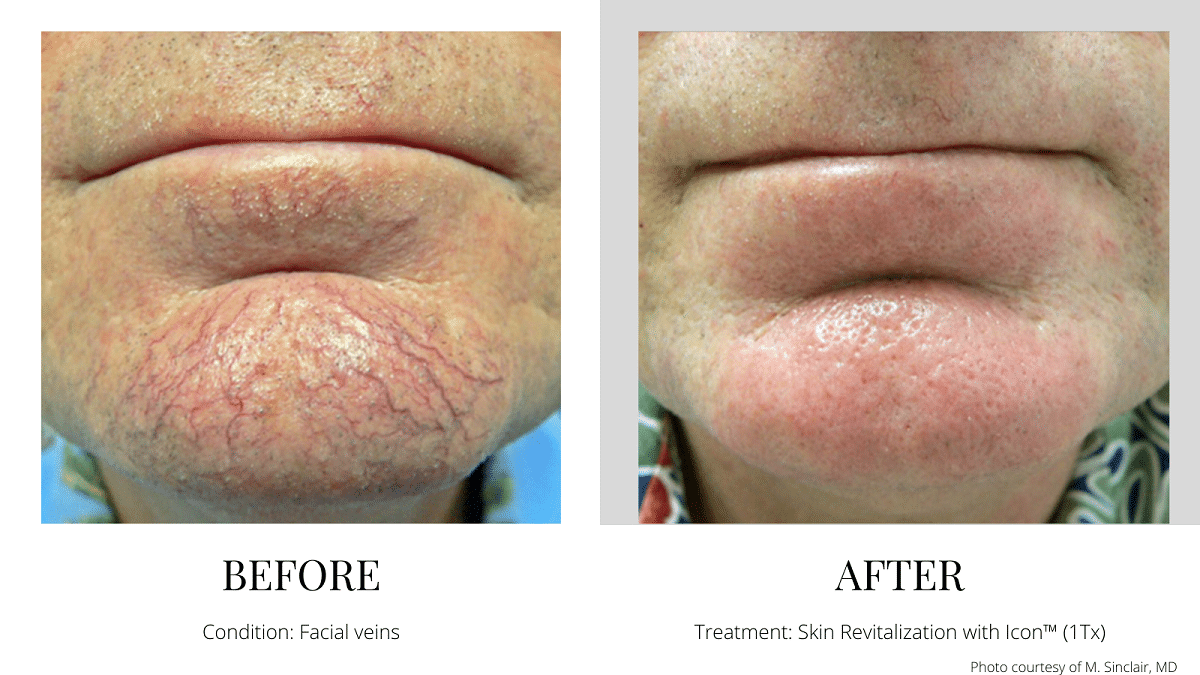 Skin Rejuvanation Revitalization IPL - Facial Veins Before and After Quincy MA