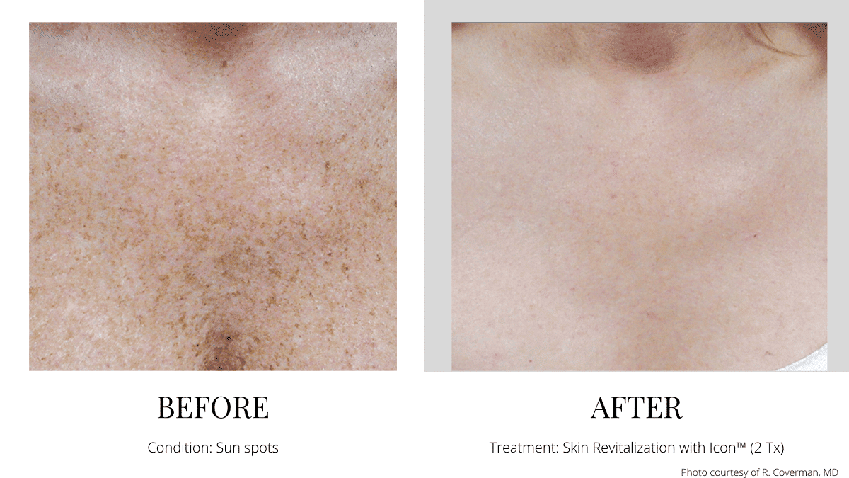 Skin Rejuvenation Revitalization - Sun Damage Before and After Quincy MA