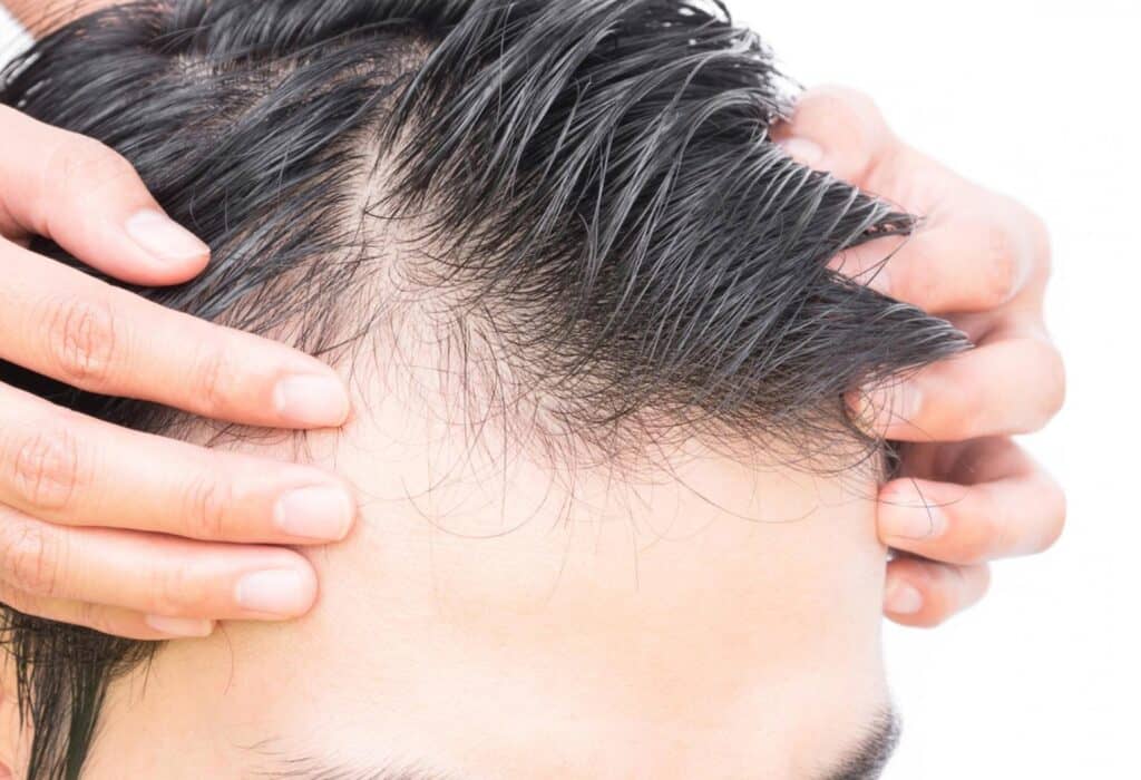 hair loss treatments