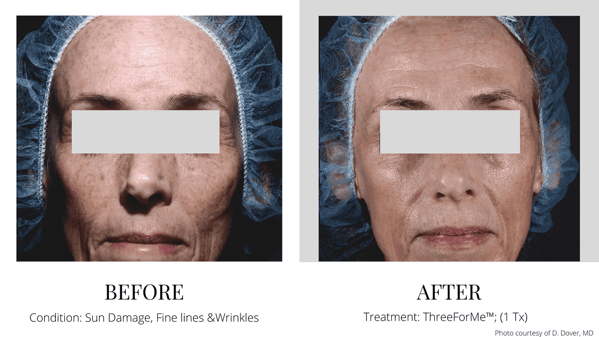 ThreeForMe Laser Treatment Before and After