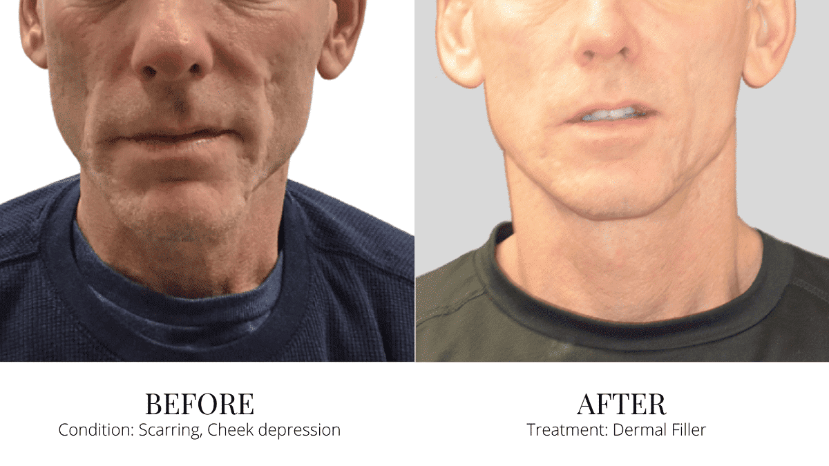 Dermal Filler Before-after