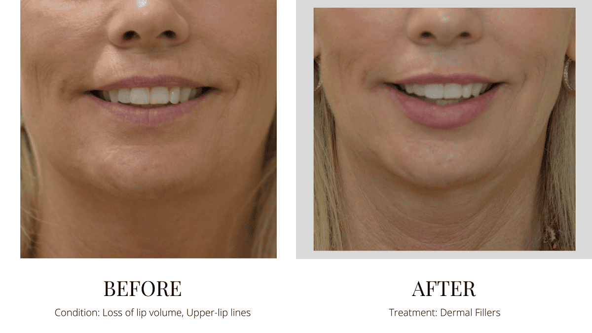 Dermal Filler_lips_ Before-after