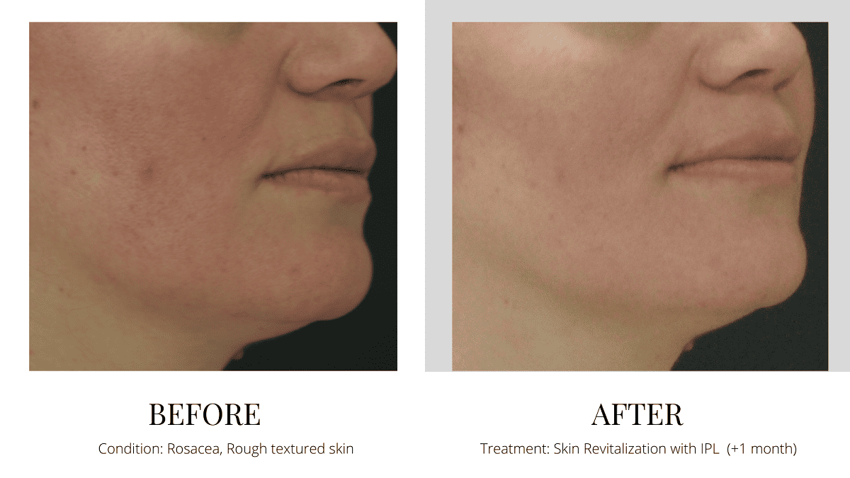 Skin Rejuvenation Revitalization IPL Before And After Marina Bay Quincy MA